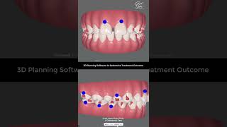 Correction of Gaps in Teeth with Invisalign Braces  Invisalign Kolkata invisalign clearaligner [upl. by Antonina]