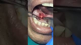 मुँह में पथरी STONE IN MOUTH SUBMANDIBULAR WHARTONS DUCT CALCULI PAINLESS  BLOODLESS REMOVAL [upl. by Arod87]