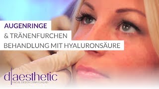 Behandlung von Augenringe und Tränenfurchen  Mit Hyaluronsäure behandeln  daesthetic [upl. by Anaerda]