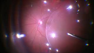 Vitrectomy for retinal detachment  Dr Manish Nagpal [upl. by Croydon655]