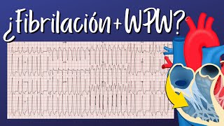 El Paciente con Fibrilación Auricular y Wolff Parkinson White [upl. by Nahama]