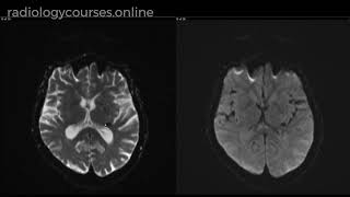 Diagnosing cavernoma when no Haem sequences are not available [upl. by Letsyrc]