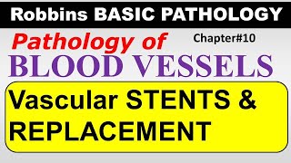 Ch10  Vascular Intervention  Stents  Replacement  Blood Vessel Pathology  Robbins Lectures [upl. by Shipp]