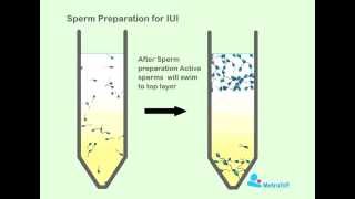 Sperm Preperation For IUI [upl. by Carpenter101]