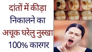 मसूड़ों में सूजन और लगे कीड़े को जड़ से खत्म कर देगा Best Tooth worm recipe [upl. by Eiluj]