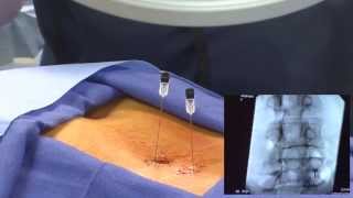 WATCH an Epidural Steroid Injection Demonstration  LIVE [upl. by Pansy113]