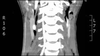 Neck Pneumomediastinum Coronal CT JETem 2018 [upl. by Redep]