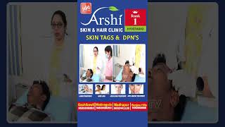 Say Goodbye to Skin Tags and DPNs Effective Treatment Solutions at Arshi Clinic arshi ytshorts [upl. by Dorraj]