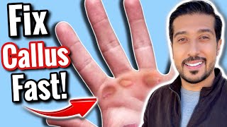 How to Get Rid of Calluses FAST in 5 EASY Steps [upl. by Eidorb538]