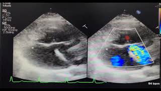 Endocardial Cushion Defect  Rastelli type C [upl. by Assirem599]