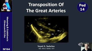 Transposition of the Great Arteries [upl. by Juana]