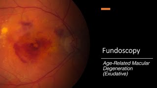 AgeRelated Macular Degeneration Exudative Fundoscopy [upl. by Aicineohp]