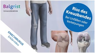 Kreuzbandriss operative Behandlung vordere Kreuzbandruptur [upl. by Nefets46]