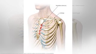 What You Need to Know About Tietze Syndrome  Tita TV [upl. by Milissa122]