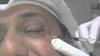 Blepharospasm and Botox Treatment [upl. by Lust]