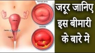 गर्भाशय ग्रीवा शोथ │ यौन संक्रमण रोग │ Cervicitis Symptoms amp Causes [upl. by Emiaj199]