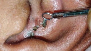 sac be spa blackheads elderly in ear👂 2025  sac be spa old age blackheads 2024  sac be spa ears 2 [upl. by Celene]