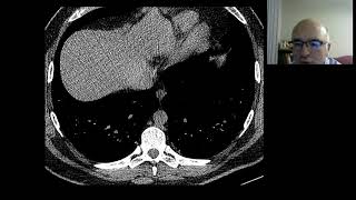 dendriform pulmoner osifikasyon [upl. by Fraser]