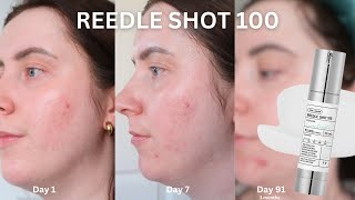 30 Days OfVT Cosmetics Reedle Shot 100  3 MONTH UPDATE [upl. by Eshman]