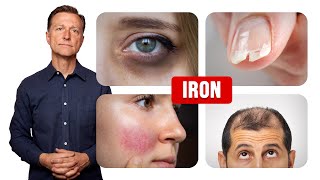 How Iron Affects Your Hair Skin and Nails [upl. by Birdella776]