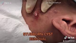 💥INFLAMMED STUBBORN EPIDERMOID CYST REMOVAL 💥 [upl. by Soigroeg]