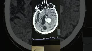 brainhemorrhagectscan radiographer radiology viral [upl. by Ydwor]