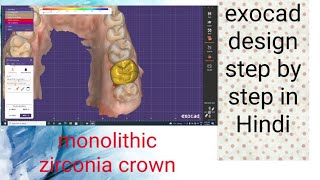 exocad crown design in hindisingle crown design in exocadexocad galway 30 [upl. by Adrahs]