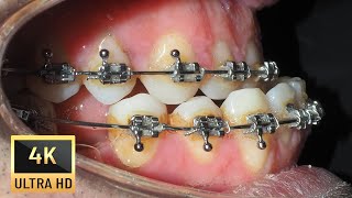 UNDERBITE in adults❗Braces time lapse [upl. by Margreta]