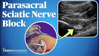 Ultrasound Guided Parasacral Sciatic Nerve Block [upl. by Crowley]