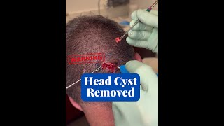 Cyst located on head EXTRACTED CONTOUR DERMATOLOGY [upl. by Arakaj]