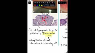 Papillae Vs Follicles in Conjunctiva  Histopathology Shorts [upl. by Assetniuq425]