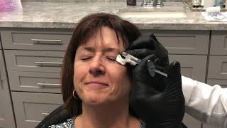 Eyebrow Lift using dermal filler by Dr Nikko [upl. by Einnaffit]