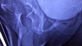 Micturating Cystourethrography MCU or Voiding Cystourethrogram [upl. by Ashman]