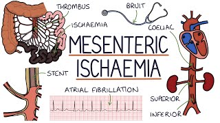 Understanding Mesenteric Ischaemia [upl. by Ahsiemak]