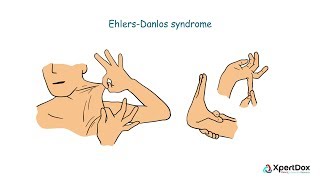 What is Ehlers Danlos Syndrome [upl. by Enitsyrhc918]