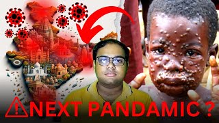 NEXT PANDAMIC Monkey Pox Signs amp Symptoms monkeypox mpox reetmukherjee [upl. by Eelymmij]