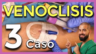 VENOCLISIS – Parte 5 CASO REAL 3 Cómo CANALIZAR una VENA [upl. by Annim713]