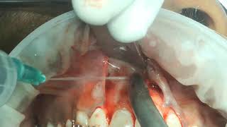 part 2 inverted and impacted  internal resobed mesiodens surgical removal [upl. by Sherrod]