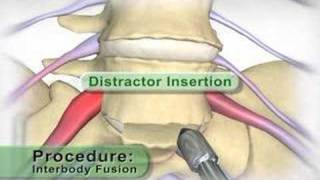 Medical Animation Lumbar Interbody Fusion [upl. by Arracot797]