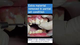 Cementation of Layered ZIRCONIA crown with GIC  step by step  shorts [upl. by Anits]