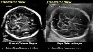 Edwards Syndrome Trisomy 18 Antenatal Ultrasound Features  Fetal USG Normal Vs Abnormal Images [upl. by Lana]