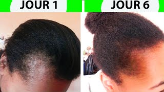 Comment Faire repousser les cheveux des tempes rapidement sans effort Faire pousser cheveux du fron [upl. by Annaeoj]