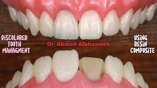 Discolored Tooth Management Using Dental Composite  Polychromatic Layering with Finishing Steps [upl. by Aeila]