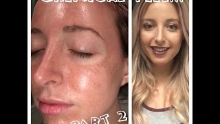 HOW TO repair sun damaged skin  My Rejuvenize Peel PART 2 [upl. by Ley]