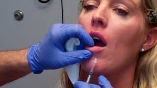 The MicroInjection Technique for Beautiful Lips [upl. by Akemehs]