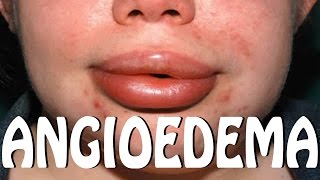 ANGIOEDEMA  INFLAMACIÓN GENERALIZADA ALERGICA [upl. by Eelirrem820]