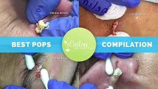 Enilsas Top 5 Best Cyst Popping Compilation [upl. by Eggleston451]