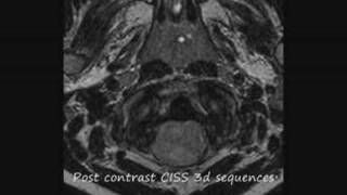 The plastic monster ependymoma how do you deal with this brain tumor in a six year old child [upl. by Aramak255]