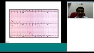 ECG in chamber enlargement Dr Ulhas Pandurangi [upl. by Nor393]