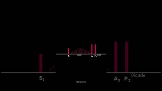 Atrial Septal Defect Heart Sound [upl. by Kcirdot49]